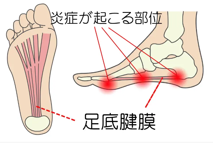 足底筋膜の主な発症箇所